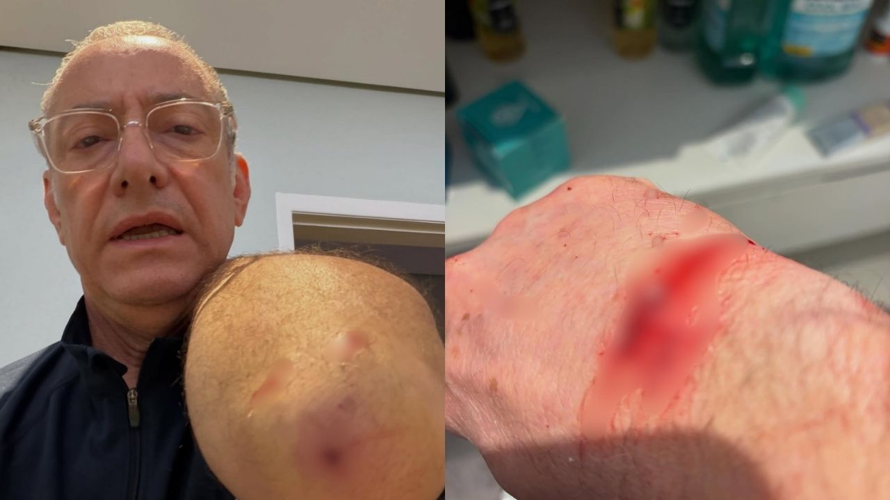 ANCORA DA GLOBO JOSE ROBERTO BURNIER E ATACADO POR PITBULL E FAZ ALERTA SOBRE LEI DE GUIAS